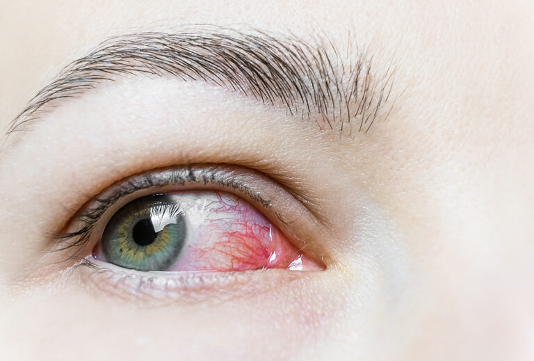 what is commonly misdiagnosed as pink eye